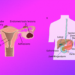 BÄM | Endometriose